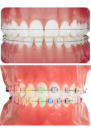 Types of Braces  Murphy & Lucas, TX - Robertson Orthodontics